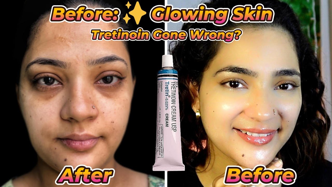 My Skin Was Glowing… Then THIS Happened After Tretinoin 😳