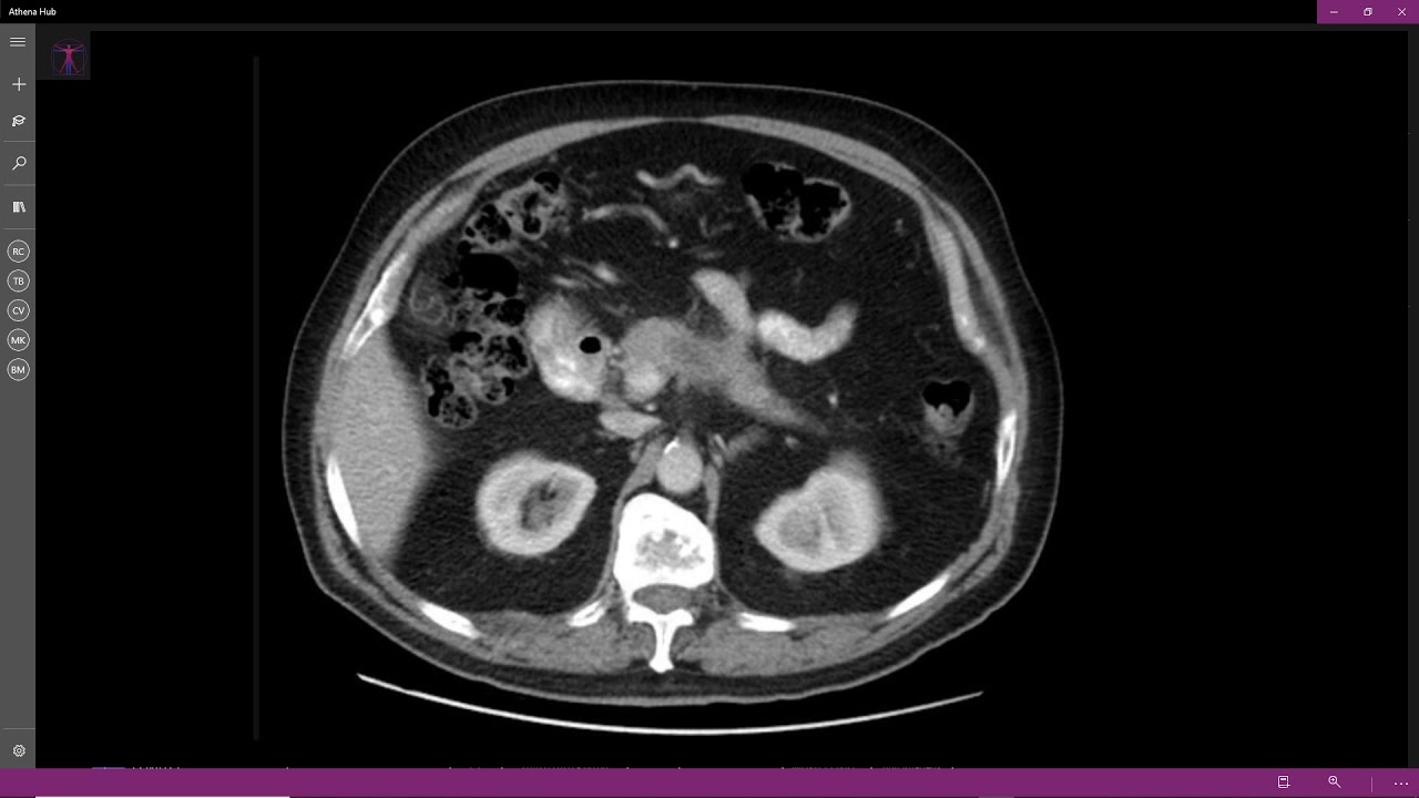 Carcinoma do pâncreas