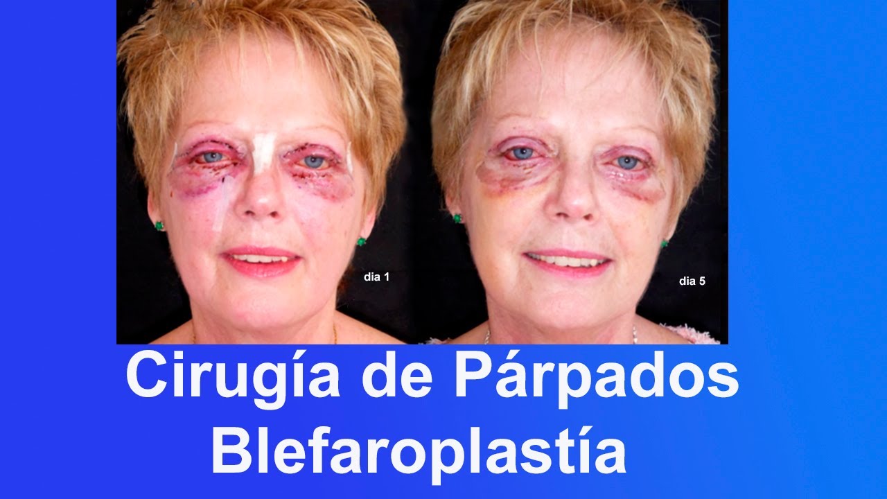 Recuperacion Blefaroplastia