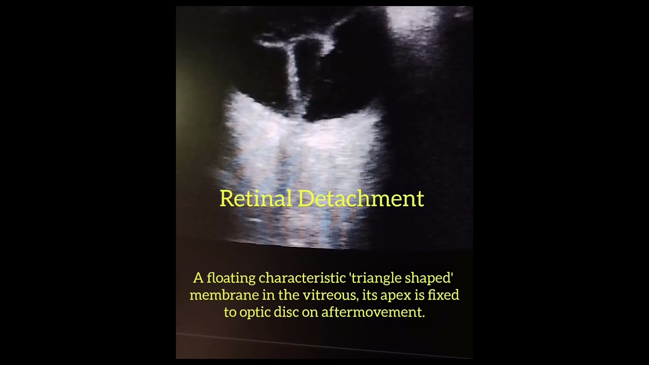 B scan of Retinal Detachment.