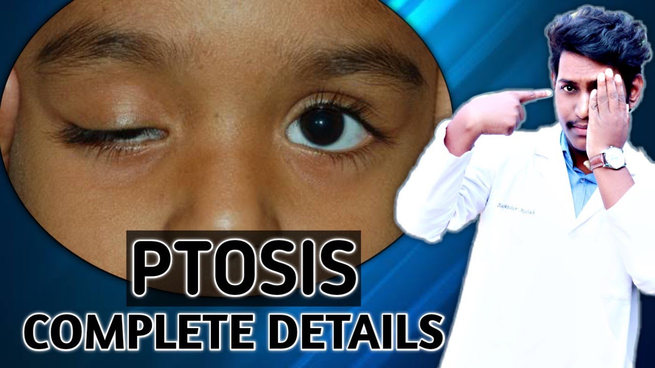 ptosis || ptosis in hindi || types of ptosis ~ congenital ptosis and acquired ptosis || VISION KING