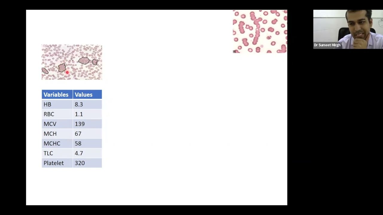 NEET-SS September 2022 Recall - Hematology | Dr. Sumeet Mirgh | Marrow Super Speciality