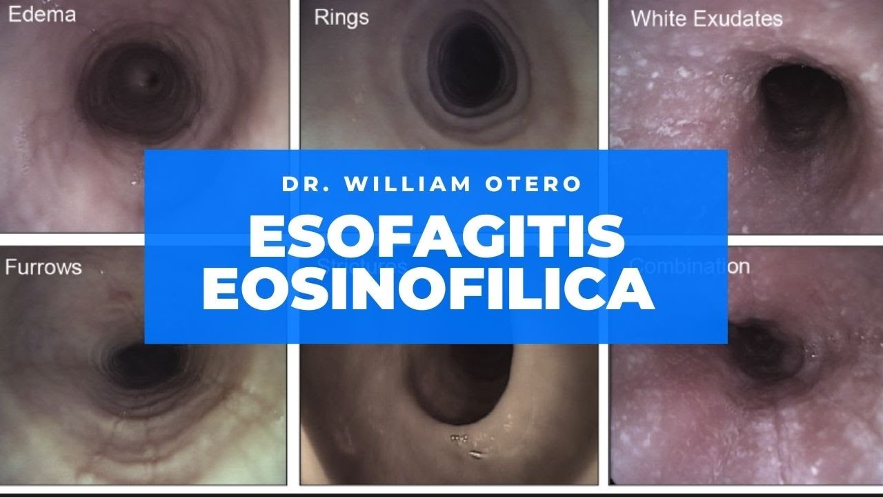 Esofagitis Eosinófilica: Cómo diagnósticarlo y tratarlo en el 2021