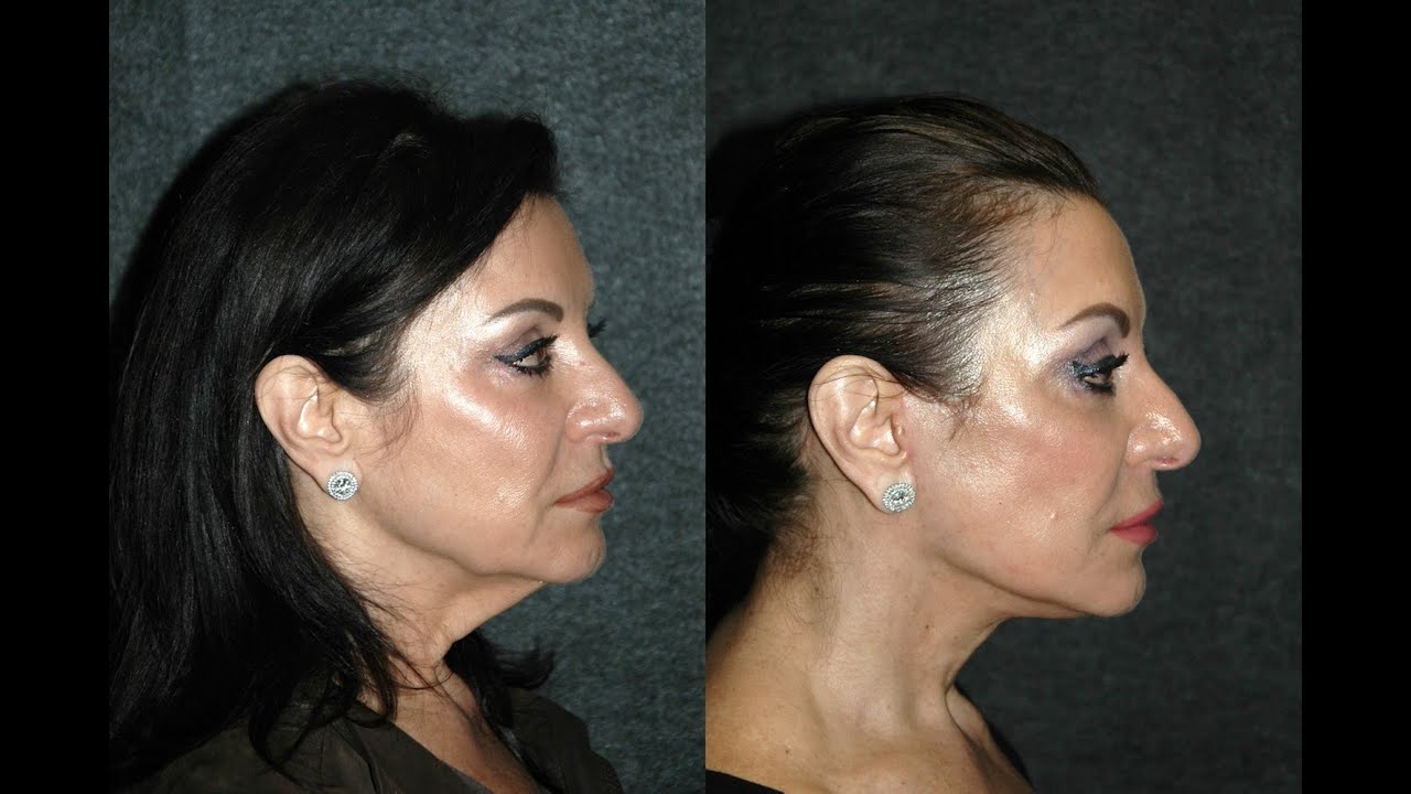 Lower Facelift Without Anesthesia #lowerfacelift