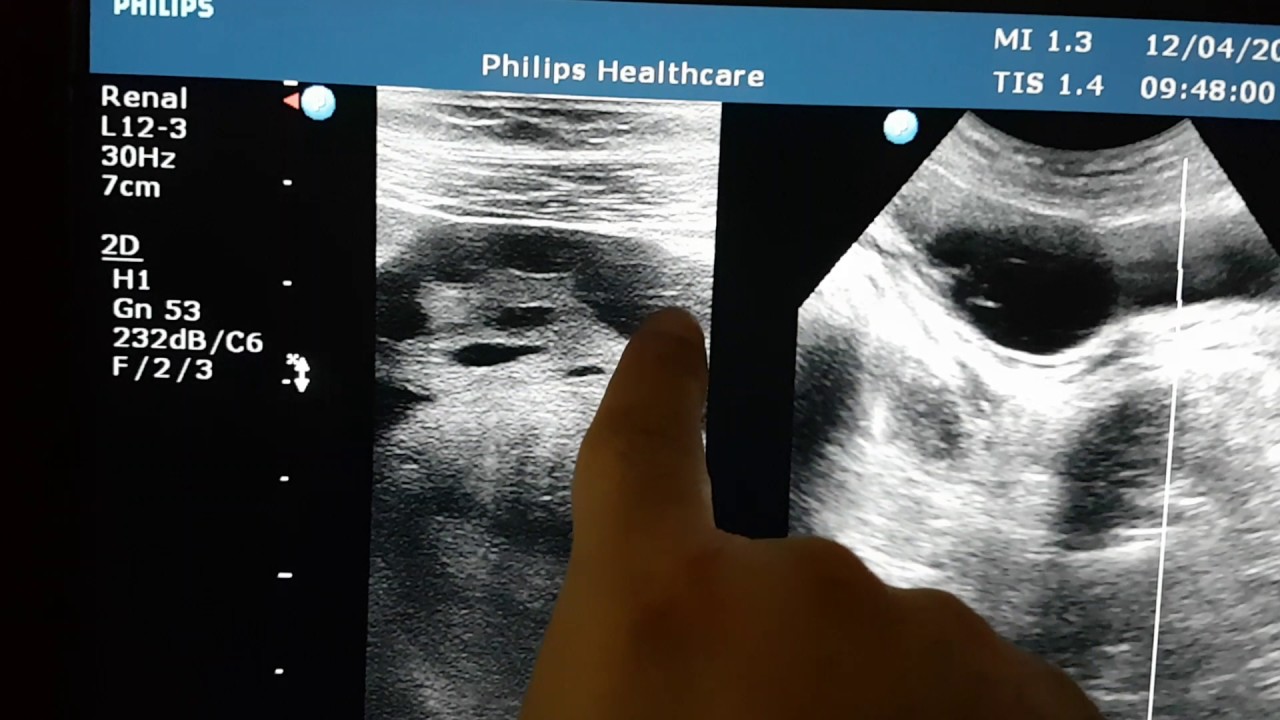 Practical Hints Sonography  : Changing the Probe