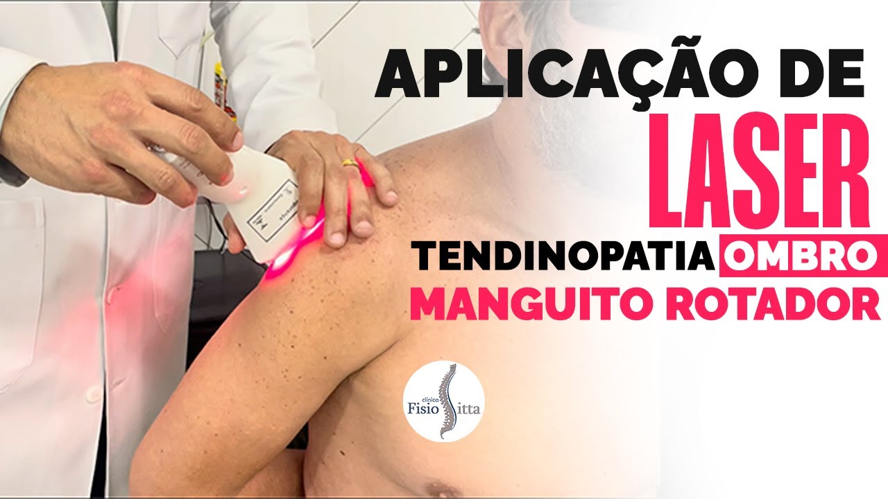 TENDINOPATIA MANGUITO ROTADOR do OMBRO - LASERTERAPIA Dr. Robson Sitta