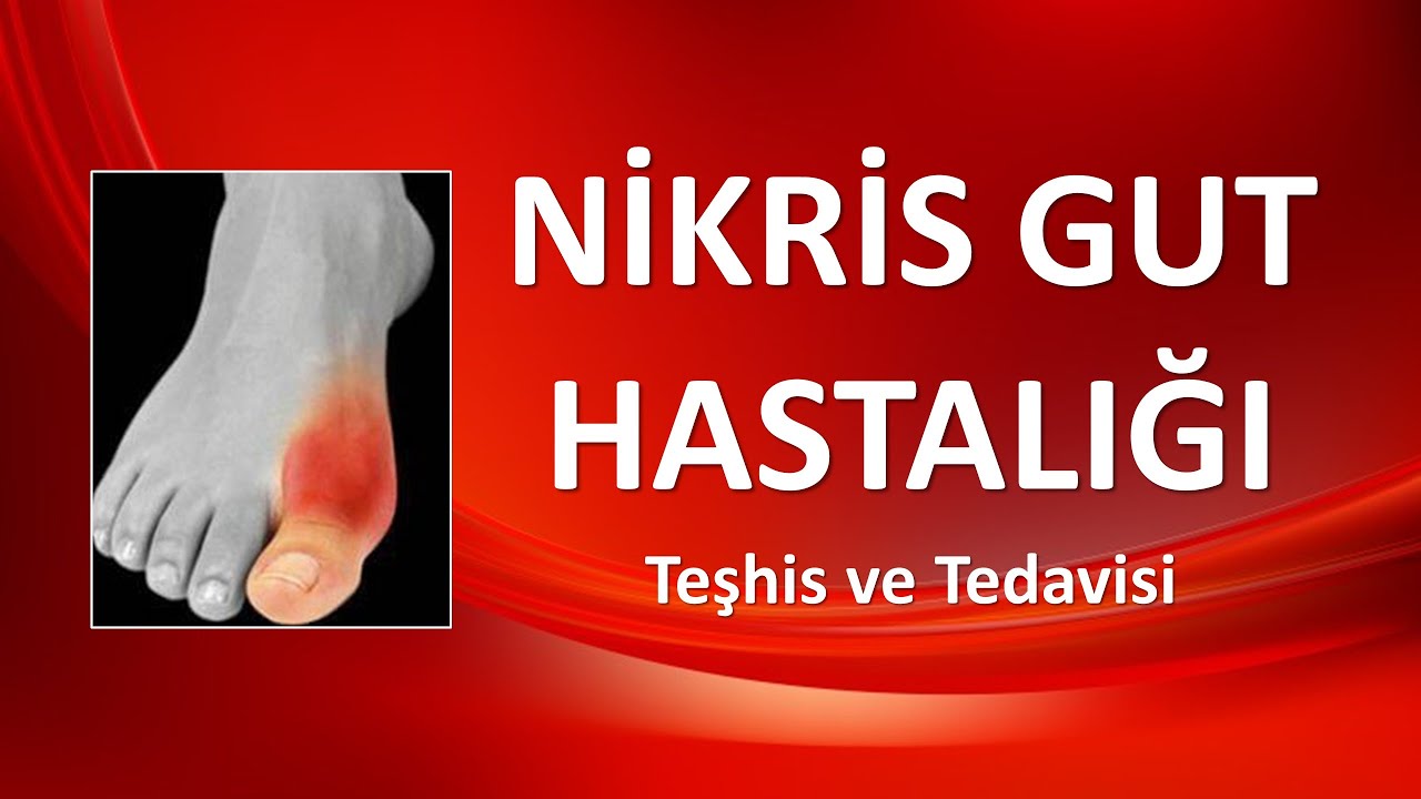 NİKRİS GUT HASTALIĞI Teşhis ve Tedavisi