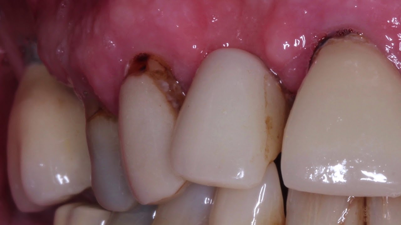 Cariology Part 7   Types of Caries