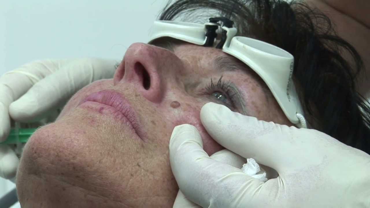 Laserabtragung von Hautmalen