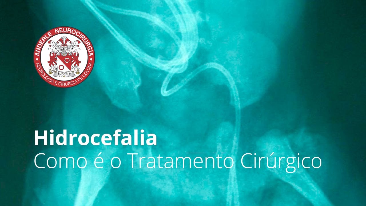 Hidrocefalia - Como é o Tratamento Cirúrgico - Dr Diogo Neurocirurgião