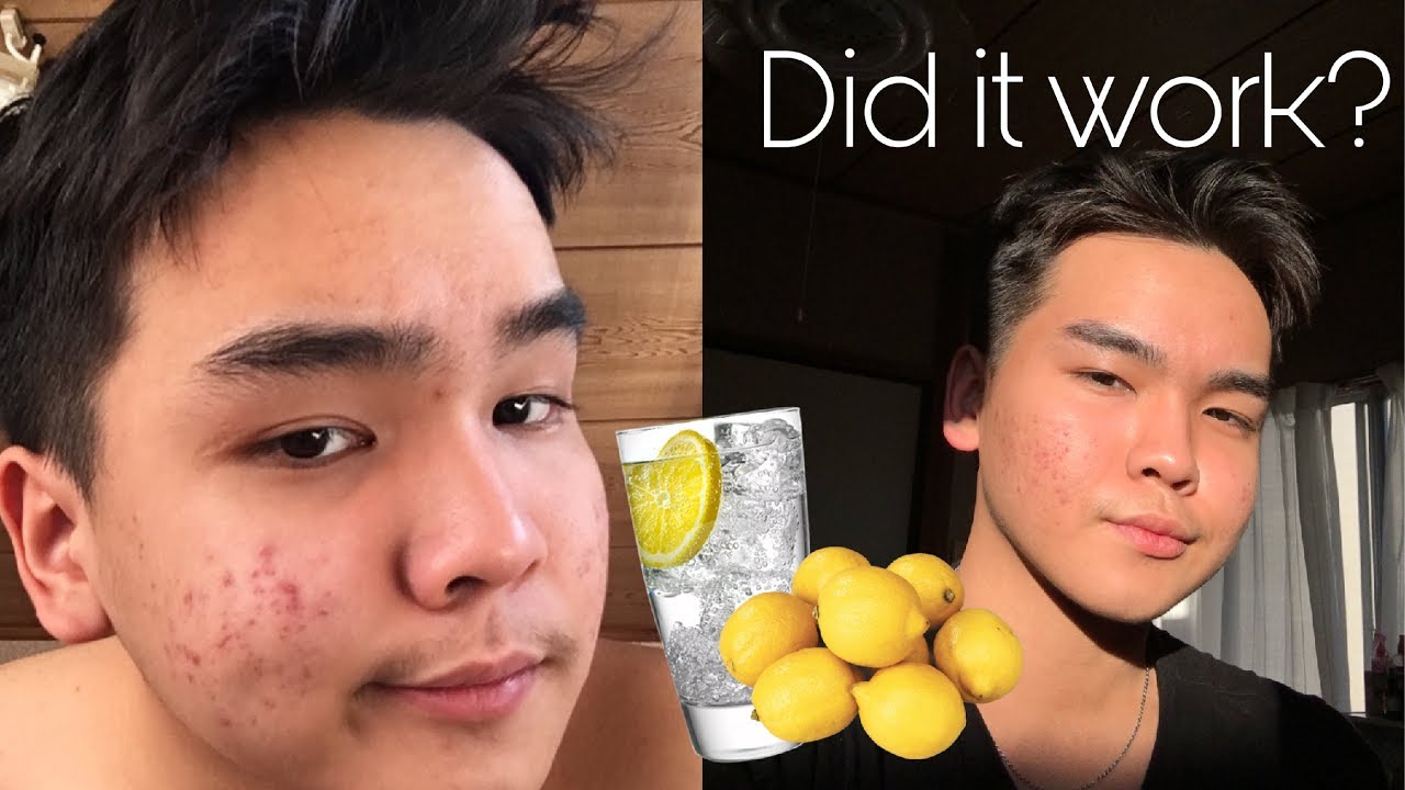 I drank Lemon Water for 7 days, did it clear my skin? | 2019