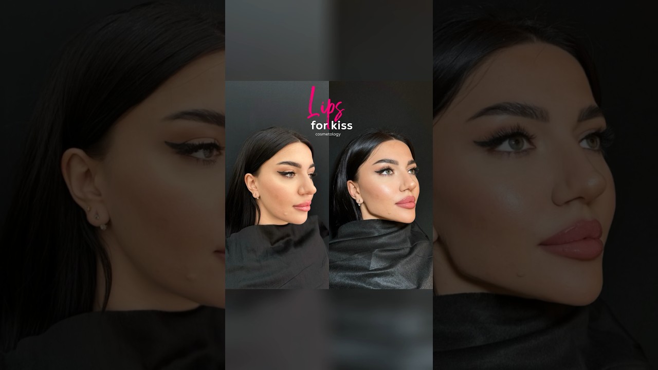 Jawline contouring 🔥 #lifting #fullface #lips #filler #jawline #contouring #botox #lipfiller