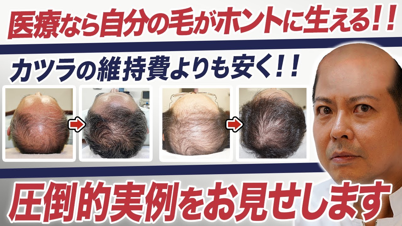【ハゲ必見！】驚異の発毛！薄毛は治せる時代