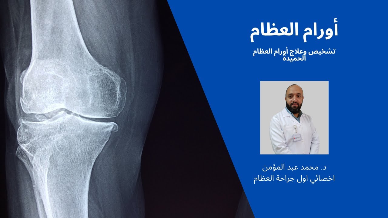 معلومات تهمك عن اورام العظام- ح1