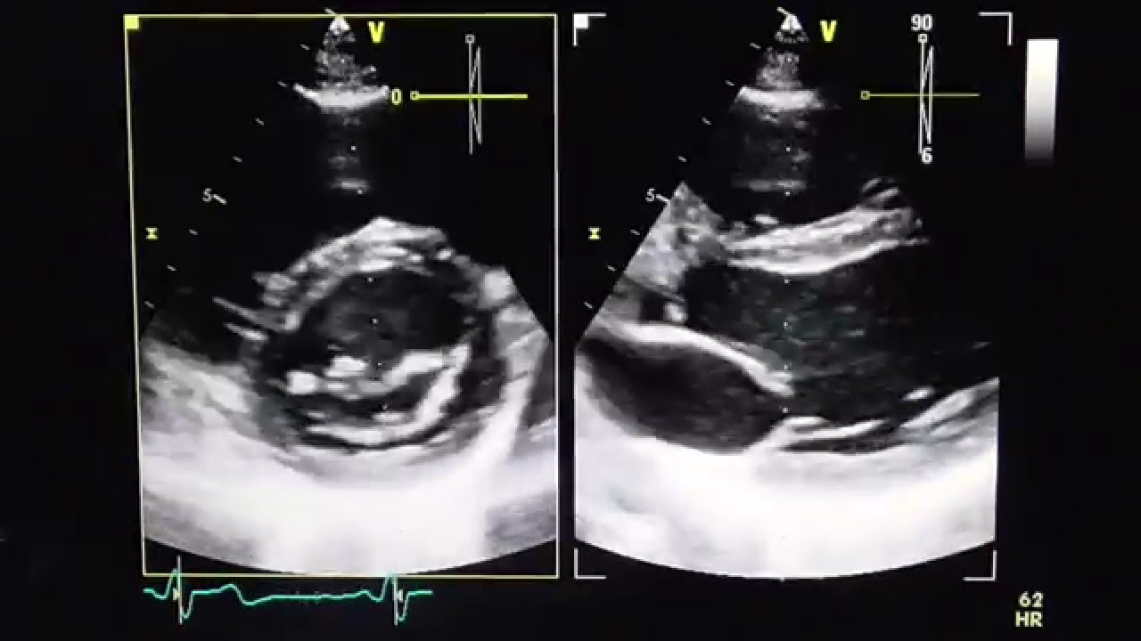 Parasternale kurze Achse auf Höhe der Mitralklappe (PTSAX-view mitral valve)