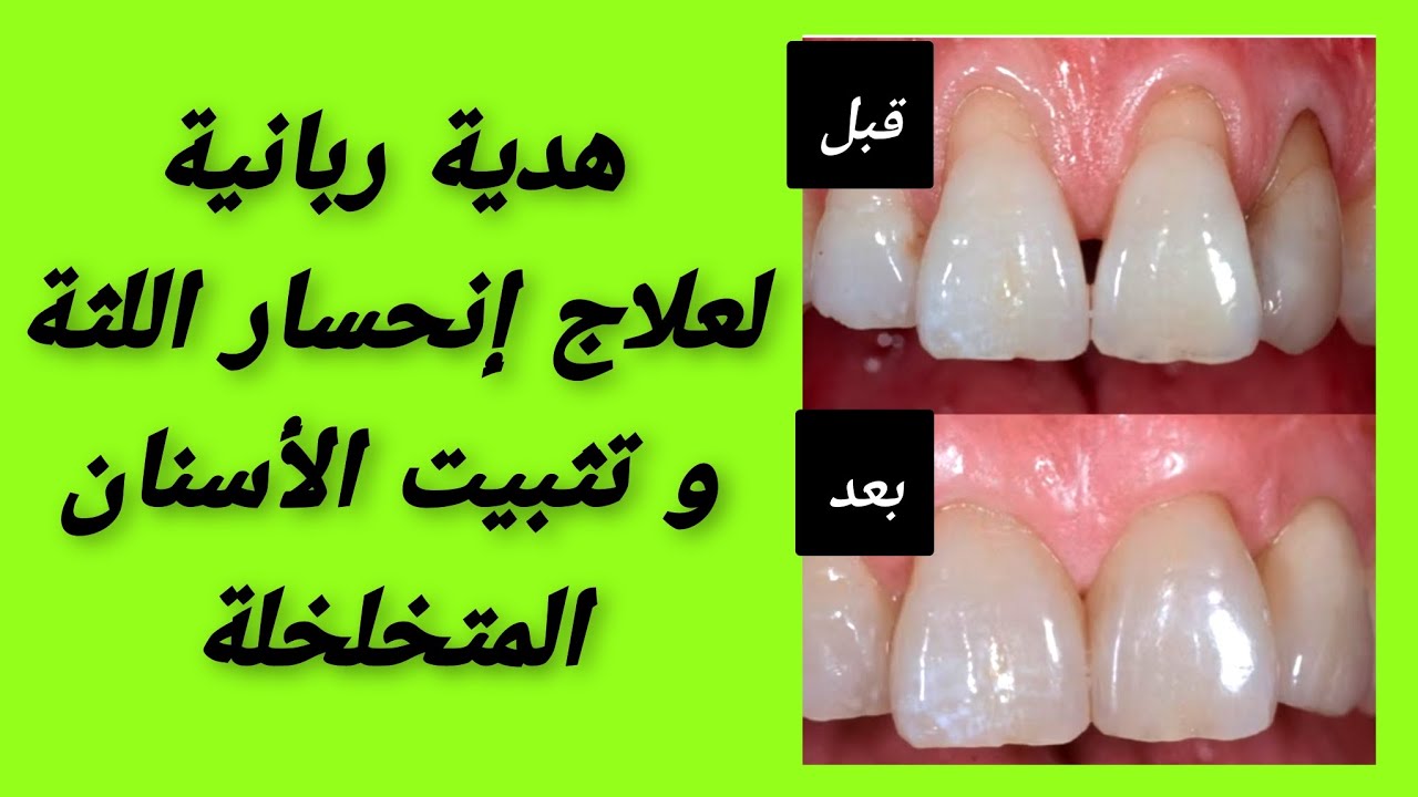 هدية ربانية لعلاج إنحسار اللثة و تثبيت الأسنان المتخلخلة ! جربها فعّالة و مُجربة 