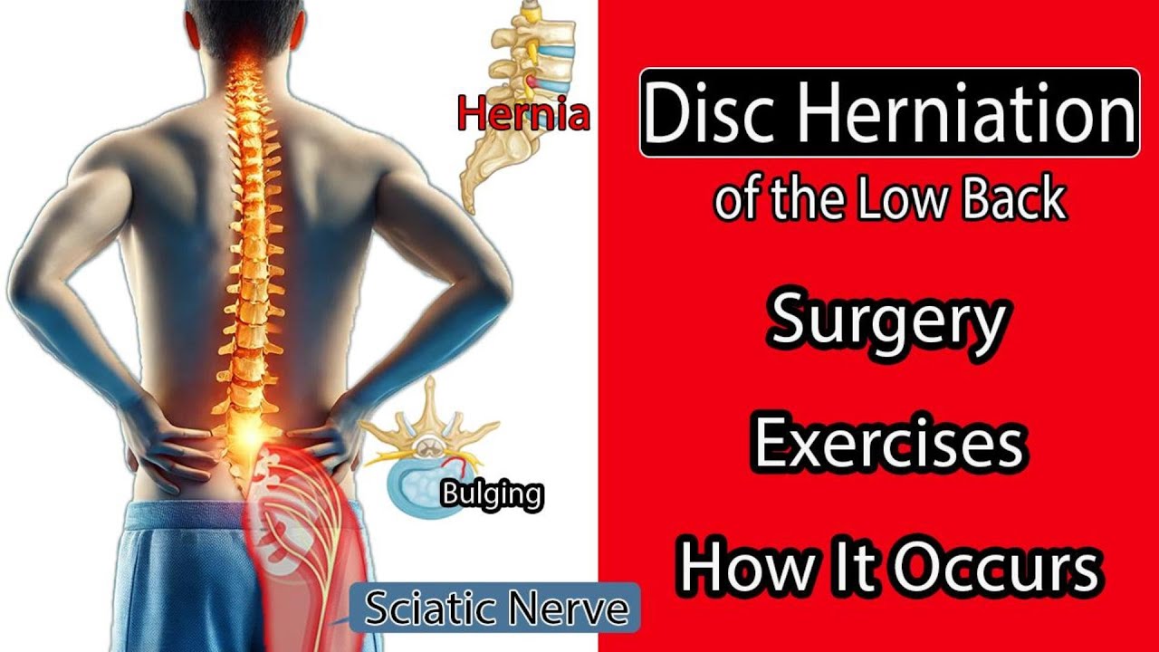 Understanding Low Back Disc Herniation: Causes and Treatment