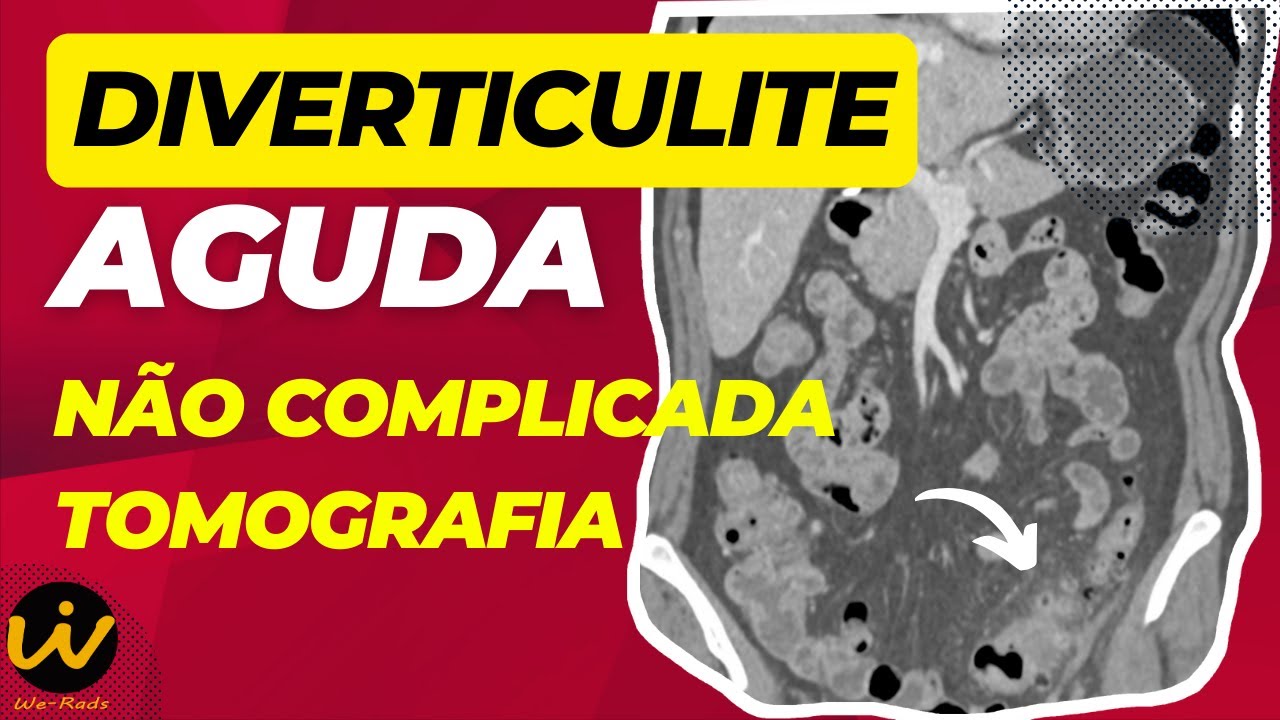 DIVERTICULITE AGUDA NÃO COMPLICADA na tomografia