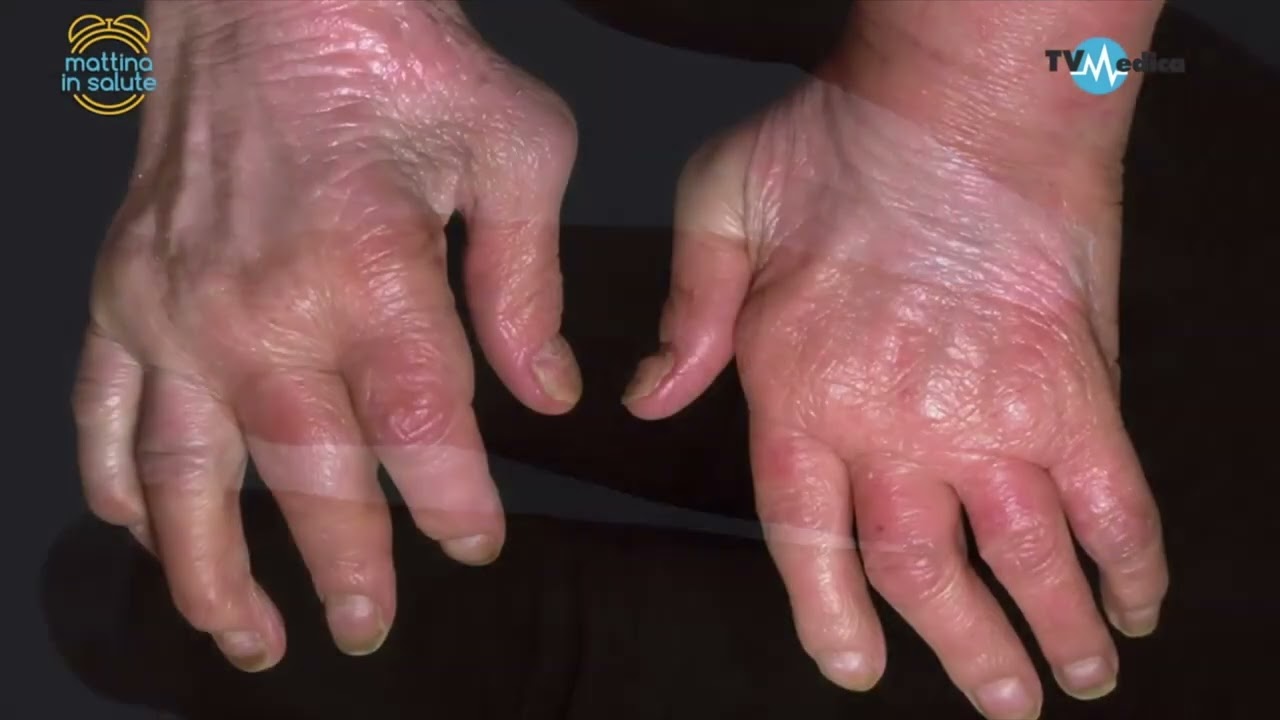 Come trattare l' artrite psoriasica