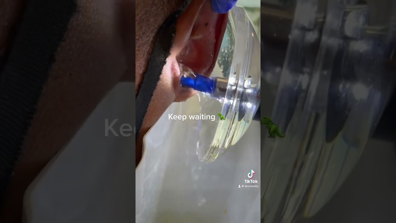 Doctor Elly removes stubborn earwax using the EARIGATOR irrigation machine (Memorial Hearing)