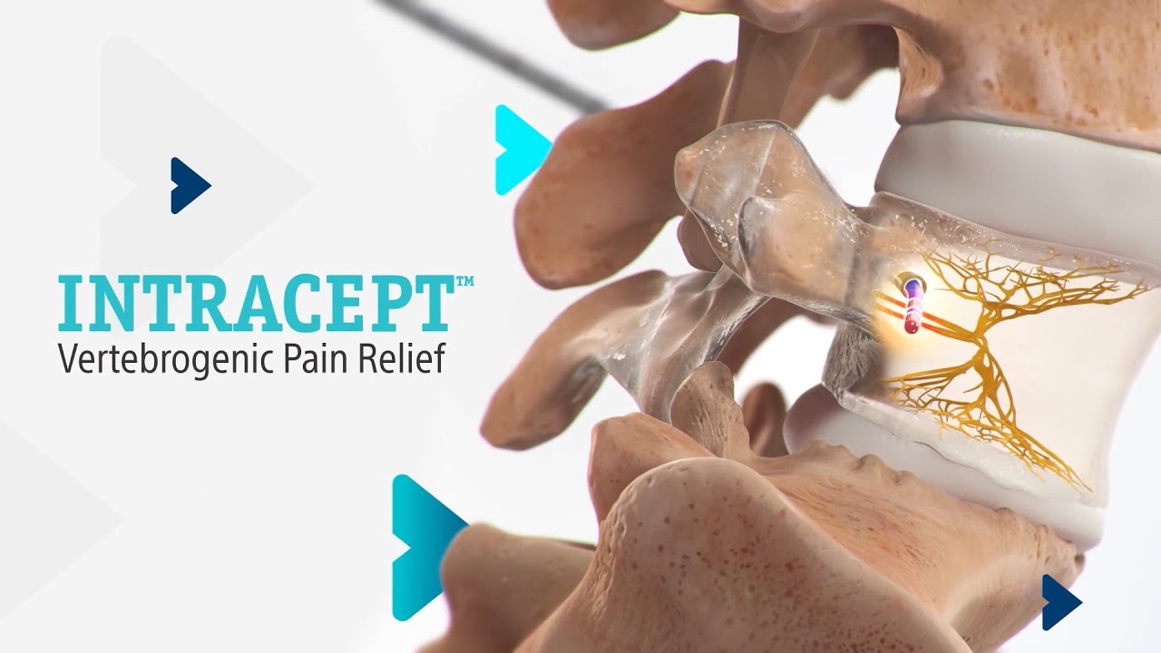 Intracept Procedure (Overview)