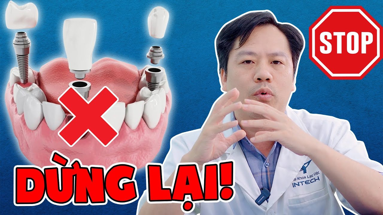 Top 3 Lưu Ý Khi Trồng Răng Implant 