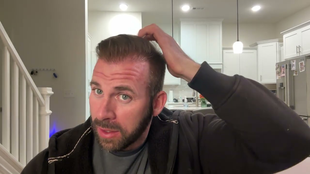 10 month update from Cosmedica Istanbul hair transplant 