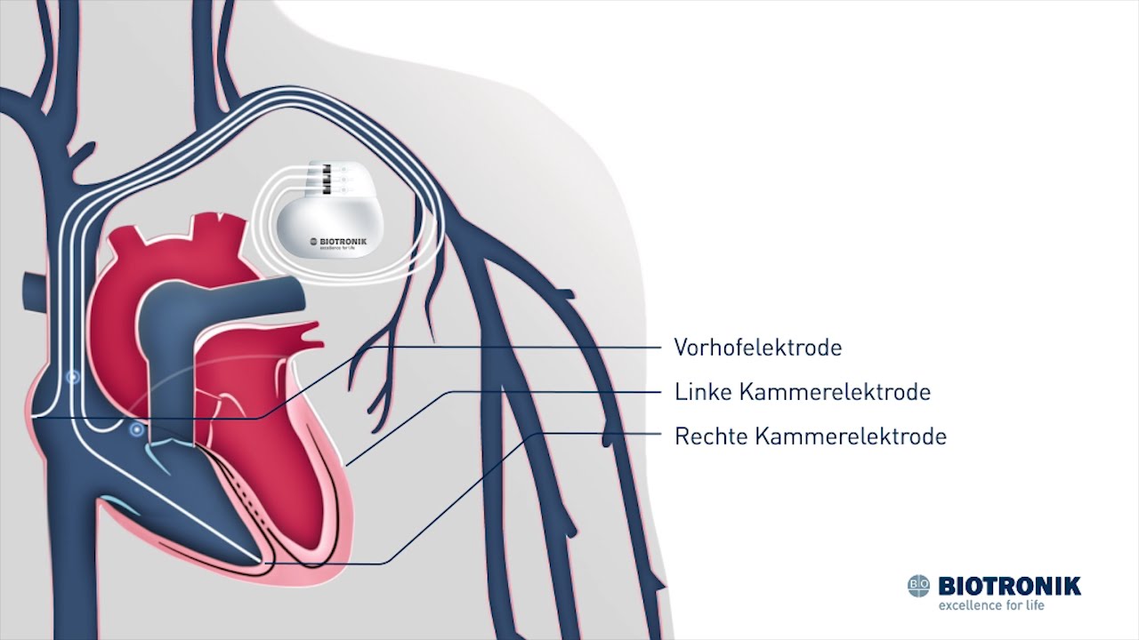 CRT Therapie bei Herzschwäche (Animation Medizin)