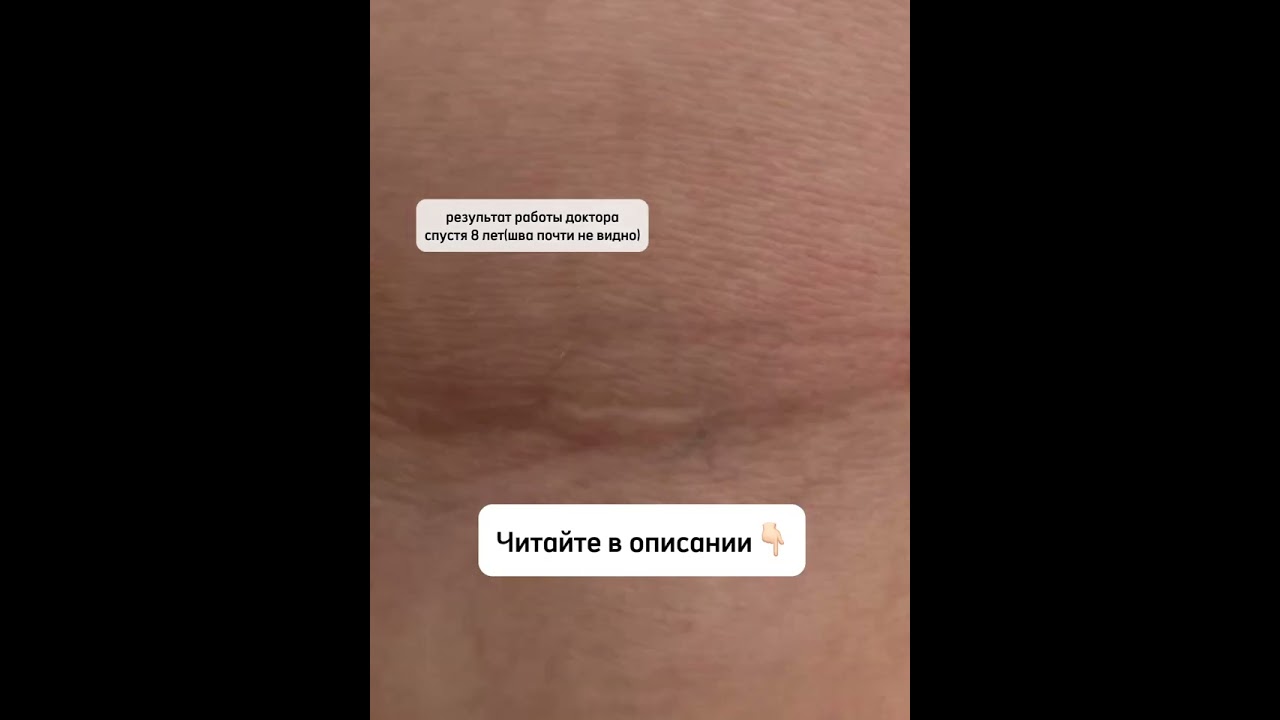 Разошелся шов после операции: что делать?  #пластическийхирург #пластика #plasticsurgeon #швы #шов