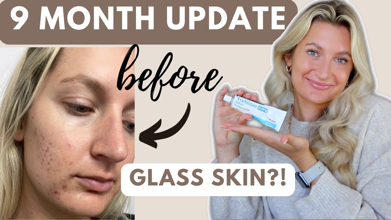 Tretinoin 9 Month Progress Update | My Skin Has Never Been SO Clear!!!