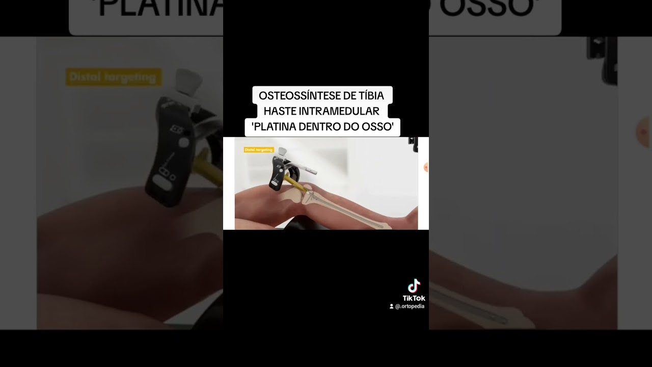 OSTEOSSÍNTESE DE TÍBIA FRATURA DIAFISARIA HASTE INTRAMEDULAR