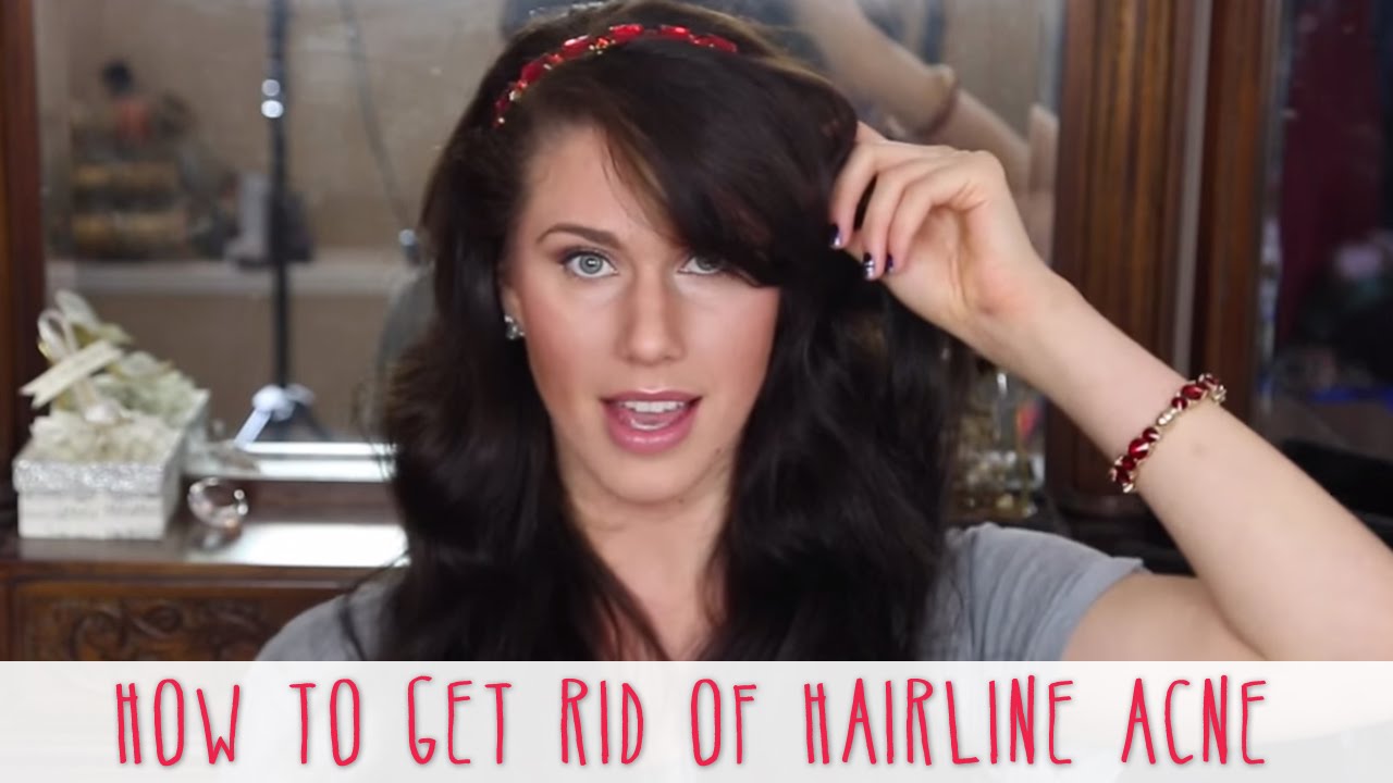 Hairline Acne and How to Get Rid of It | Cassandra Bankson