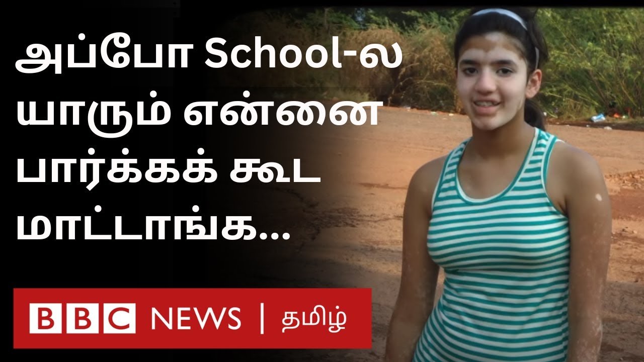 அழகு என்பது என்ன? Vitiligo நபர்கள் பகிரும் அனுபவங்கள்....
