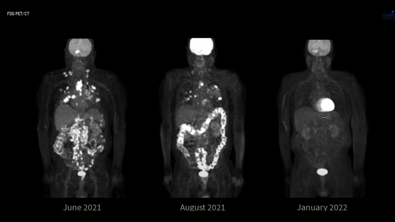 F-18 FDG PET/CT Metastatic Lung Cancer