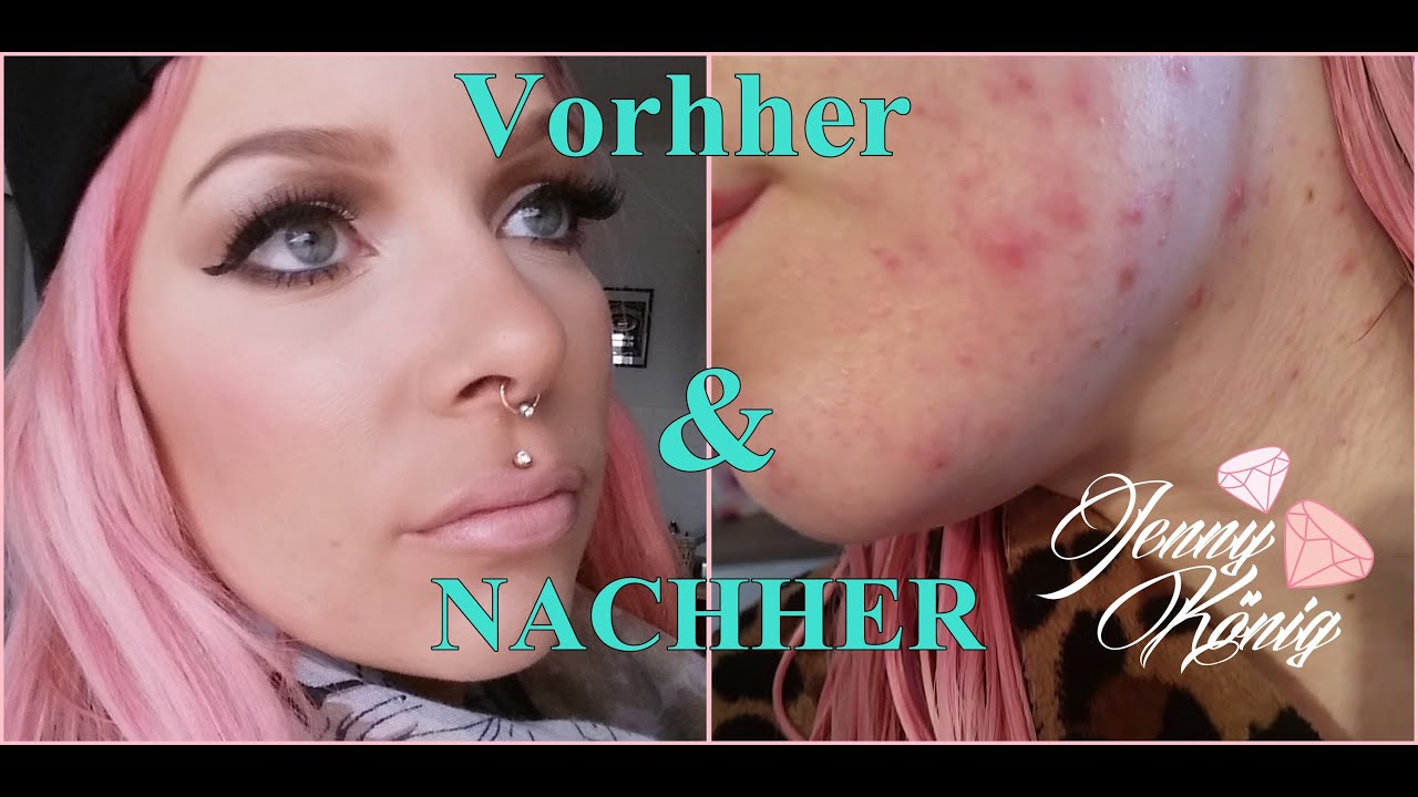 So decke ich meine Pickel/Akne perfekt ab ! 5 Schritte