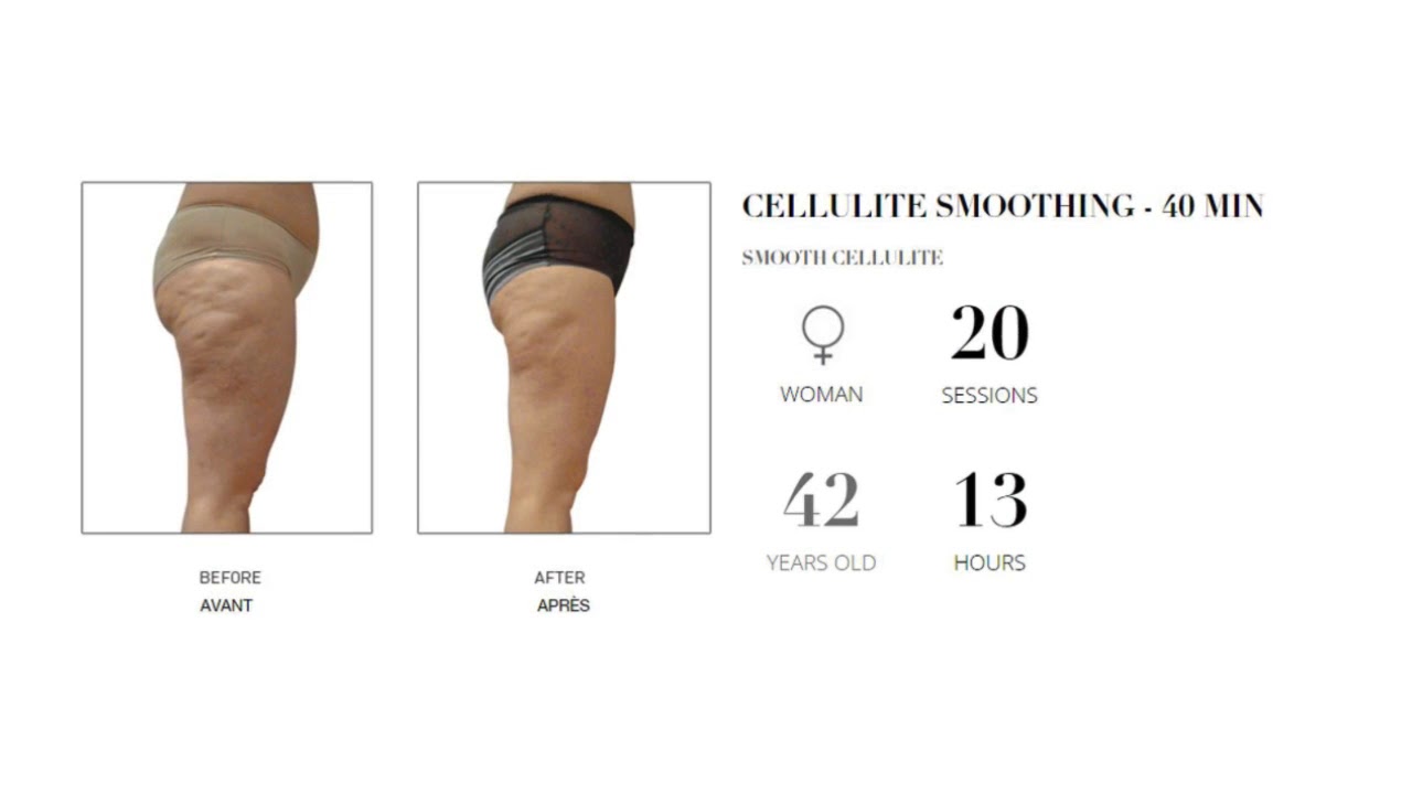 LPG by Endermologie Results -  Euro Charm Skincare  Body Clinic - Vancouver
