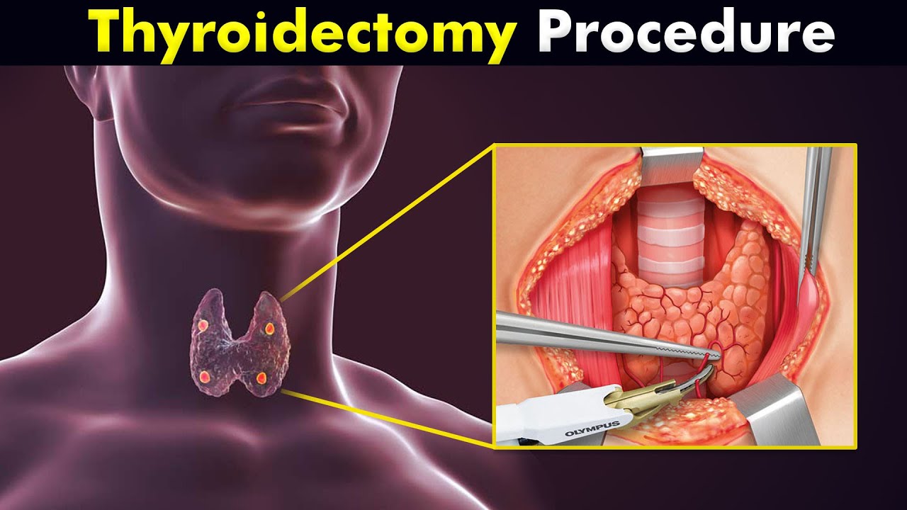 How is Total Thyroidectomy Performed? Procedure, Reasons, and Aftercare