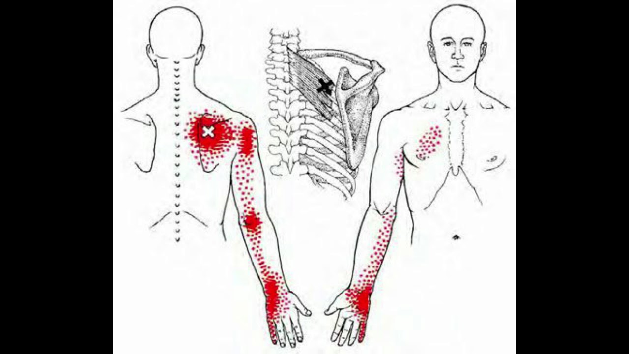 Active Release Technique of Rhomboids Muscle