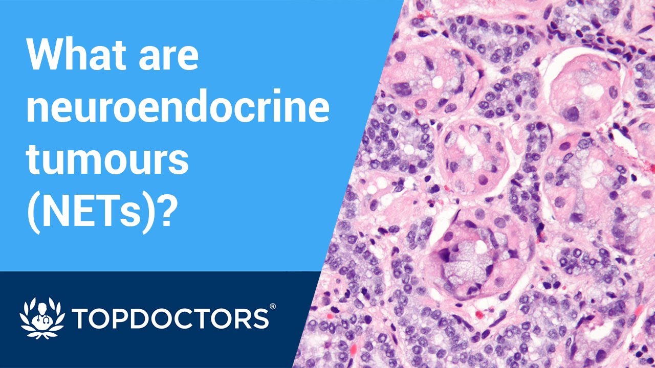 Neuroendocrine tumours (NETs): symptoms, diagnosis and treatment