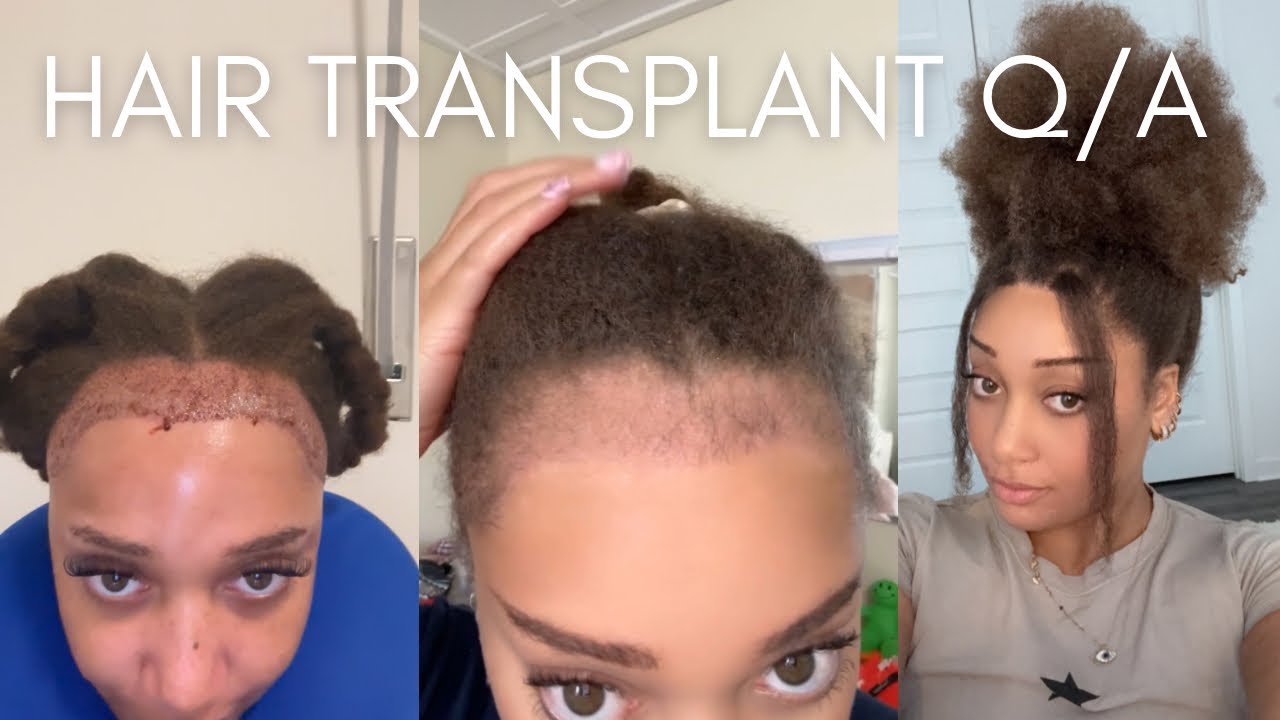 2 YEAR POST HAIR TRANSPLANT Q/A + STORY TIMES