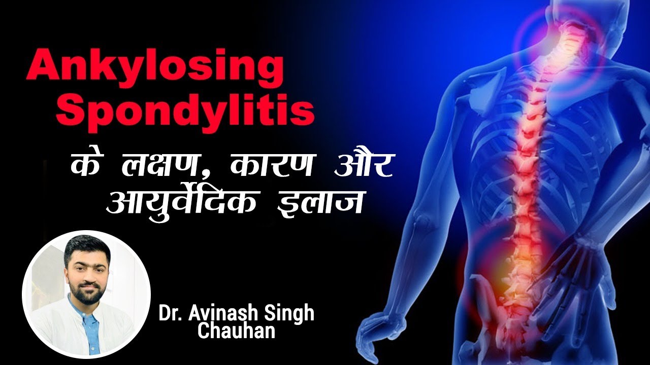 Ankylosing Spondylitis