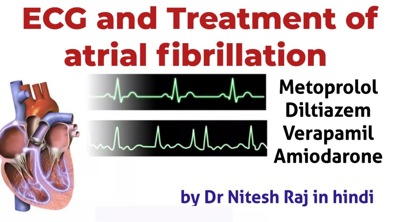 Atrial Fibrillation ecg and treatment in hindi #drniteshraj
