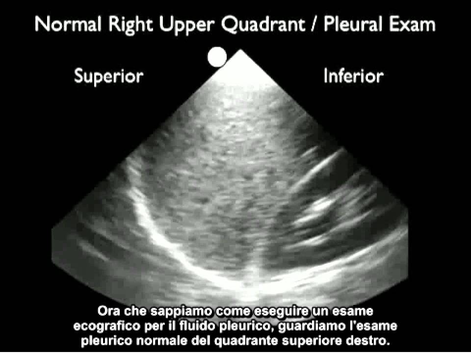 Video procedurale: Rilevazione del liquido pleurico con ecografia