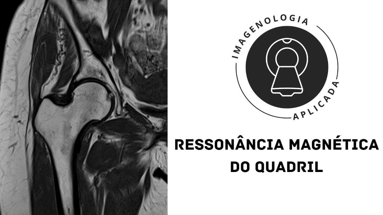 Ressonância Magnética do Quadril.