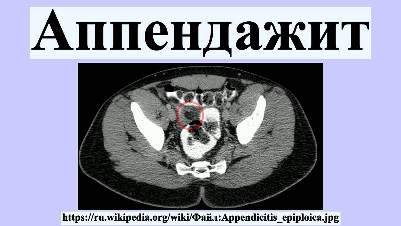 Аппендажит