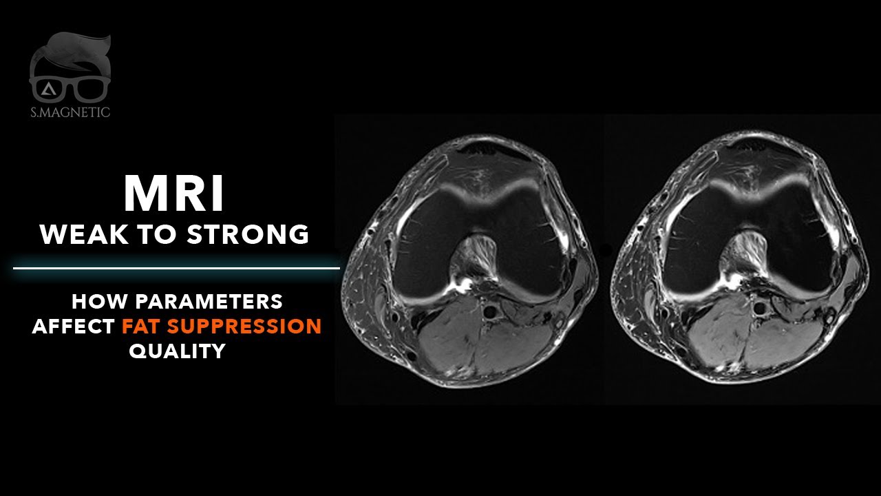 MRI – WEAK TO STRONG : HOW PARAMETERS AFFECT FAT SUPPRESSION QUALITY