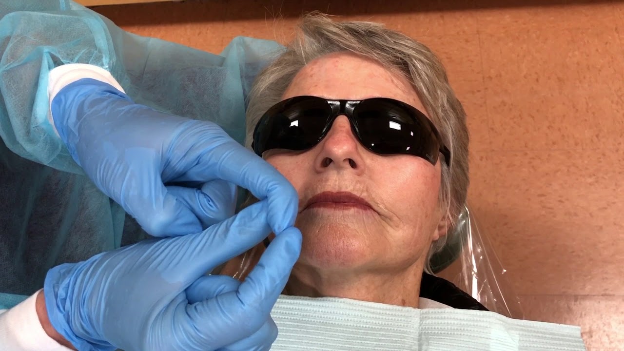 Posterior Superior Alveolar Nerve Block