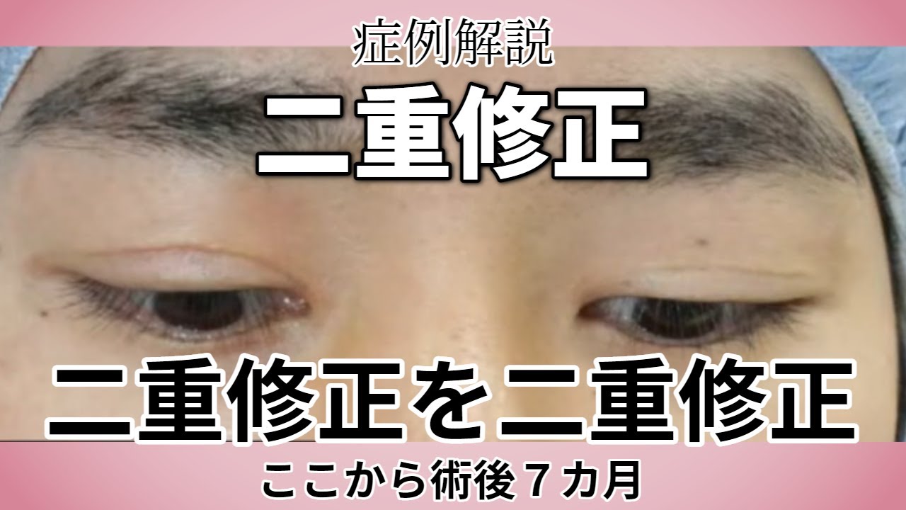 男性の二重修正 症例解説／幅狭く～手術後７か月 動画あり