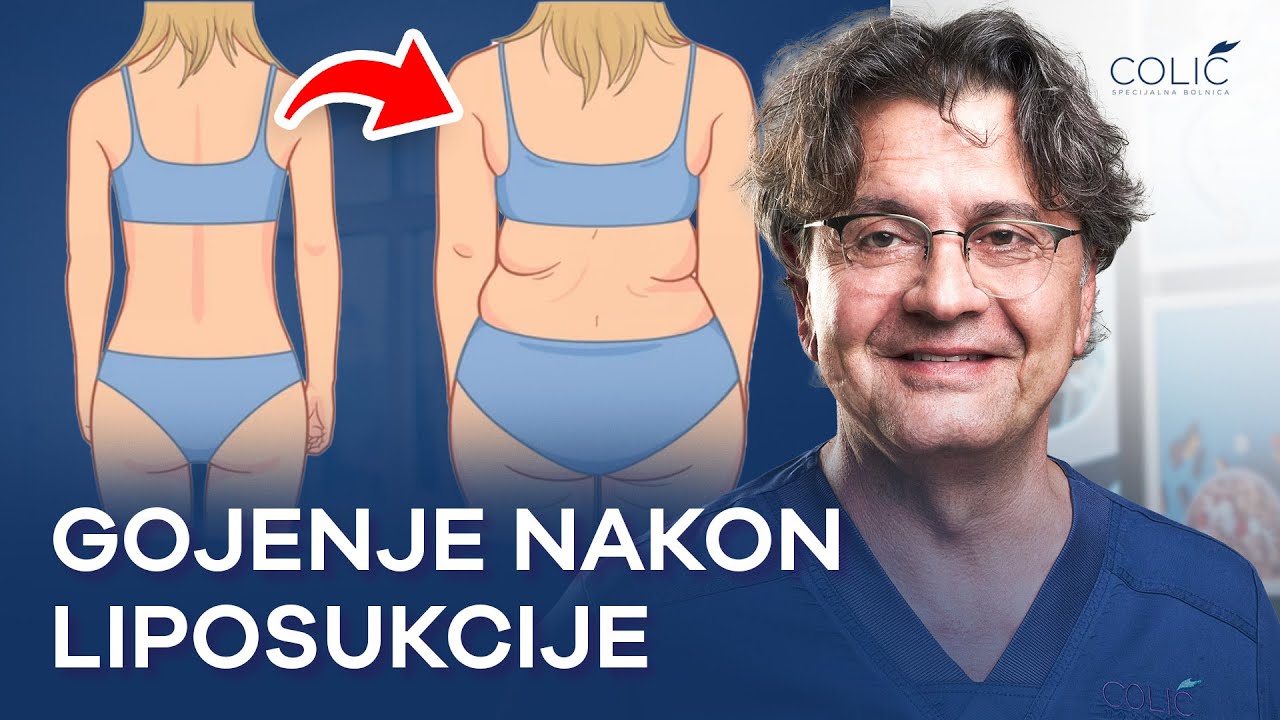 Jak zachowuje się ciało po liposukcji i jak nie wr&oacute;cić do &bdquo;starej&rdquo; formy | Dr Milan Colić