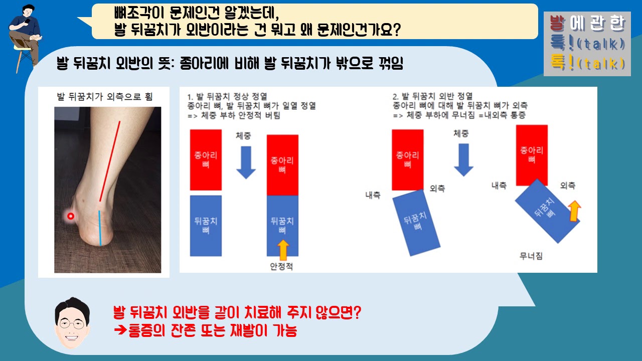 {발톡!}, 비골하 부골, 부주상골이 동반된 발뒤꿈치 변형의 수술적치료